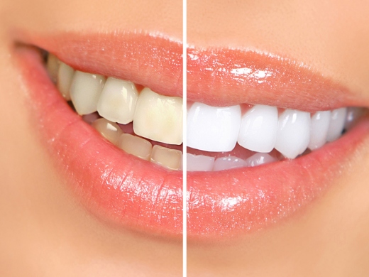 Home Whitening Treatment Available from Clinica Dental La Plaza Javea
