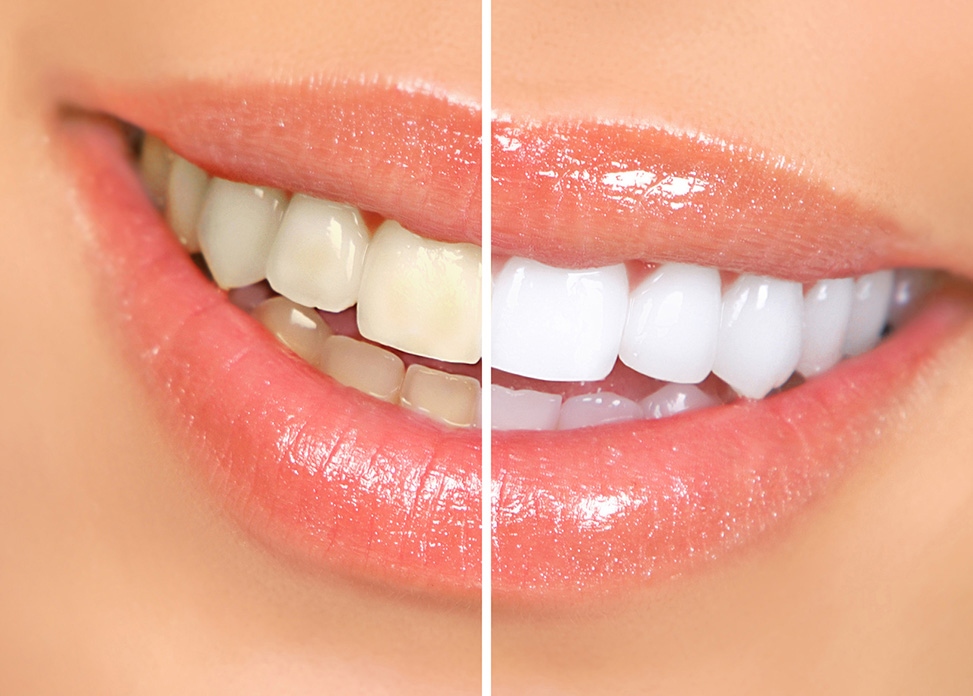 Home Whitening Treatment Available from Clinica Dental La Plaza Javea