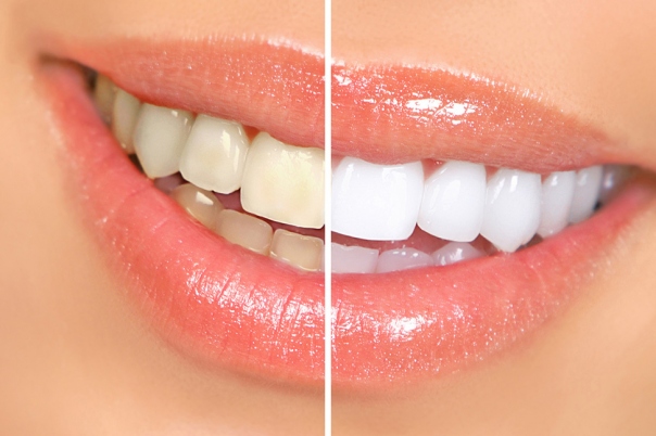 Home Whitening Treatment Available from Clinica Dental La Plaza Javea